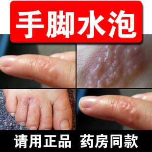手上长水泡痒汗疹膏手指头长水泡珍脚上起水泡痒手上起小水泡痒