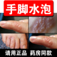 手上长水泡痒汗疹膏手指头长水泡珍脚上起水泡痒手上起小水泡痒