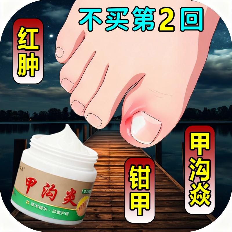 甲沟脚指甲疼大拇指往肉里长销肿感染发红肿化脓脚指甲止痛膏