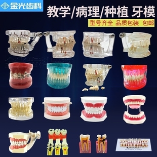 牙模型牙科教学模型可拆卸医患沟通教学备牙牙齿口腔假牙模型摆件