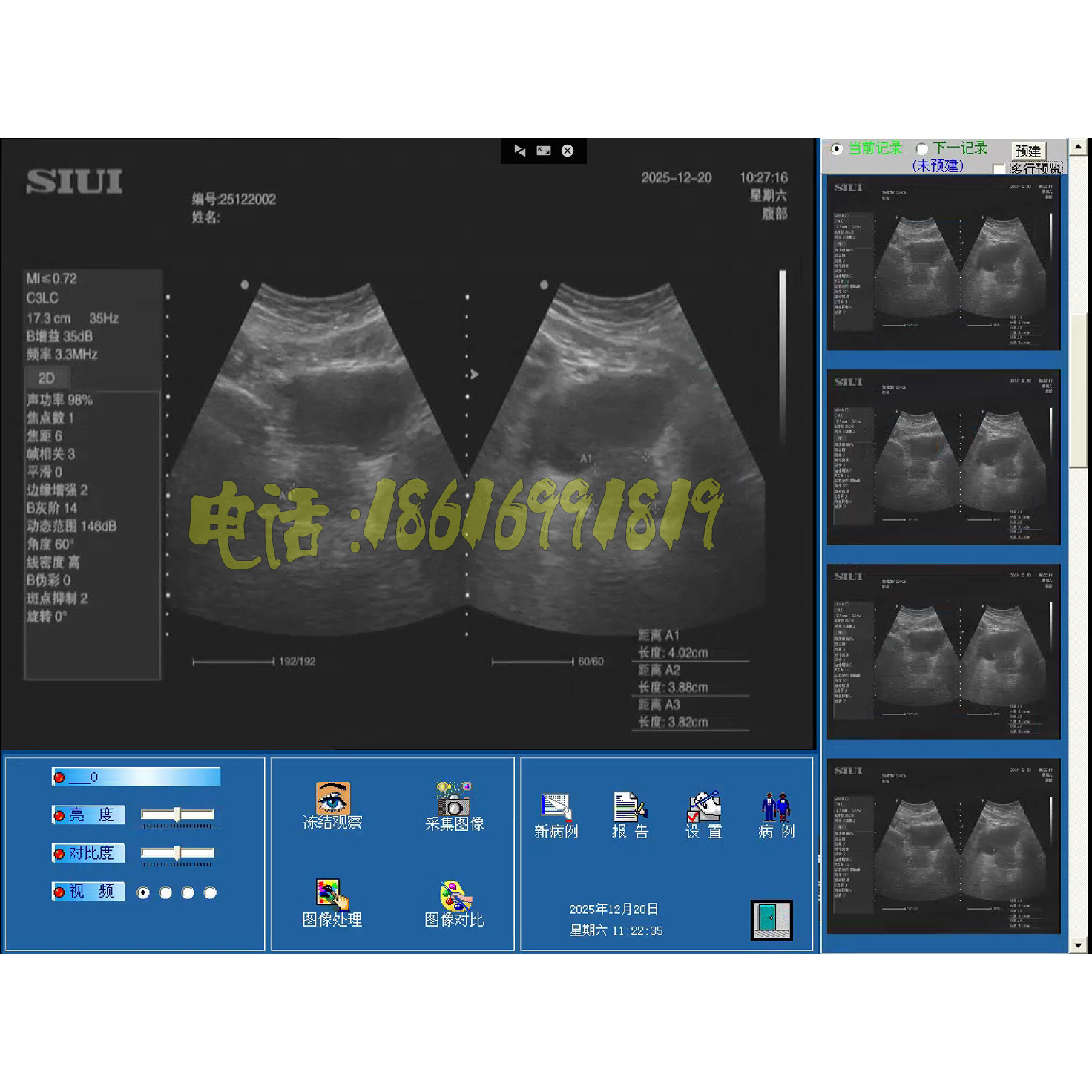 超声随心所欲XP版超声随心所欲WIN7版超声WIN10版B超/彩超软件