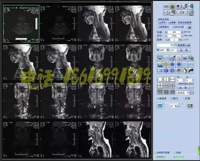 放射Pacs软件CT工作站软件CT软件DR软件CR工作站软件核磁MRI软件