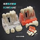 牙科4倍种植解说牙模型牙冠可拆卸种植钉展示模型医患沟通