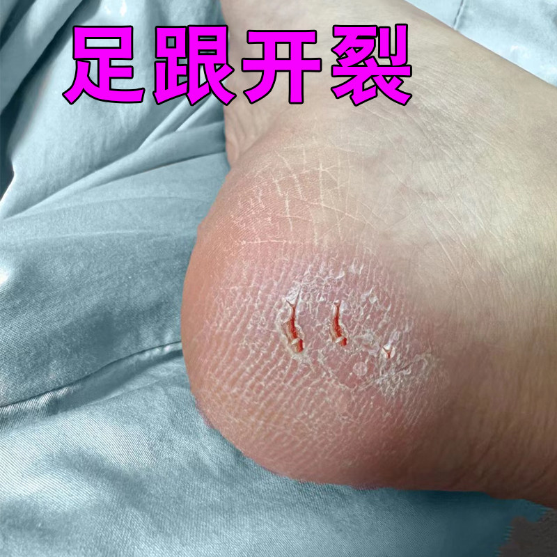 脚后跟干裂修复贴开裂皲裂足裂膏脱皮痒专治脚裂起皮起硬皮修复霜