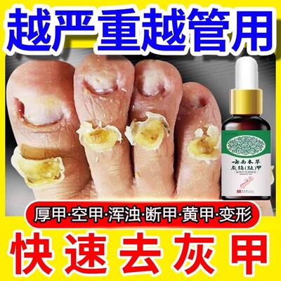 云南本草灰指甲液生长液生甲抑菌液亮甲灰甲液脚趾增厚软甲脱甲液