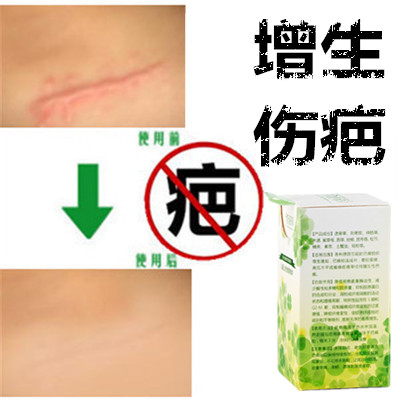 草本软化增生性祛凸起疙瘩修复精华液去除手术产后开刀割伤疤痕印