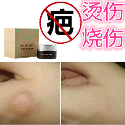 祛除烟烫凹凸疙瘩淡化黑色素沉淀消去烟烫增生性烧伤巴药膏疤痕印