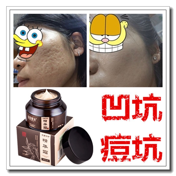 祛男痘坑精华液淡化痘印痘疤不留疤痕灵芦荟胶去凹洞修复收缩毛孔
