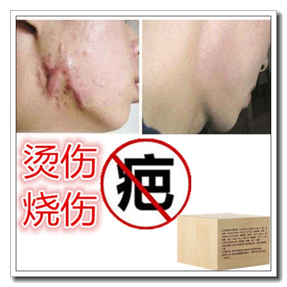 正品祛烟烫疙瘩淡化儿童增生性凹凸手术烧伤药疤痕印消去色素药膏