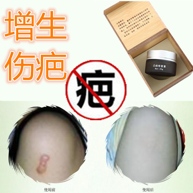 除手术修复药膏增生性凸疙瘩消去破宫产伤疤痕印灵淡化缝针祛摔伤