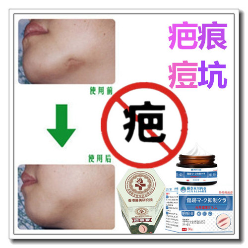 消除手术疙瘩软化增生性体质烟烫去凸疤祛产后伤疤痕印灵缝针药膏