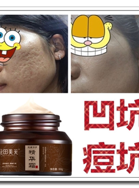 祛凹陷再生长修复膏淡化闭合痘坑痘疤痘印正品消去填平儿童凹坑霜
