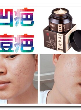 去凹洞修复凹陷疤痕祛刀巴净治凹痕疤痘坑淡化痘印痘疤修护冻伤疤