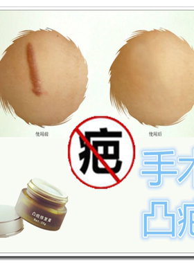 去除脸部烫伤疤痕的药膏产品祛男女增生性老疤淡化黑色素沉着凝胶