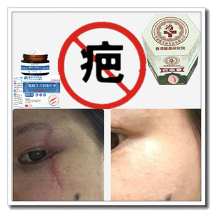 去手术后色素斑印修复增生性凸疤疙瘩体质伤疤痕印灵烟烫药膏正品