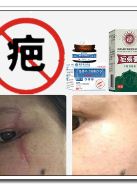 软化烟烫消祛增生性凹凸疙瘩除去手术缝针产后色素伤疤痕印灵斑印