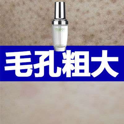 正品改善黑头豆印白头控油补水收缩毛孔面部精华缩小毛孔粗大克星