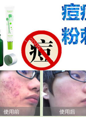 产品暗疮痘痘立消除祛前胸后背酒刺黑头痤疮液去豆豆脂肪粒豆印平