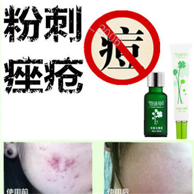 去除男女士黑头封闭合性痤疮痘痘正品粉刺暗疮儿童青春痘豆修复霜