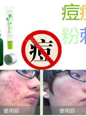 产品药用去油性痤疮黑头豆痘平脂肪粒面疮前胸后背部酒刺粉刺全清