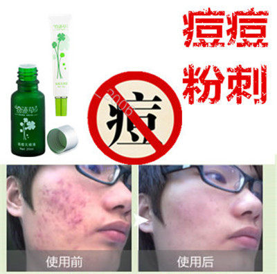 暗疮去前胸后背部酒刺油性痤疮粉刺平封闭合性痘痘消除祛脂肪粒液