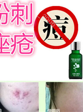 去除后背部封闭合性痤疮修复膏青春痘痘快速清除去额头粉刺豆豆霜