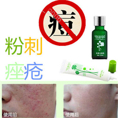 奇迹草本正品祛青少年酒刺痤疮封闭合痘痘立消除去后背部豆豆粉刺