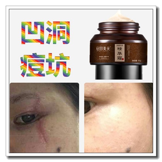 祛除凹陷痘疤痕灵快速淡化凹坑去痘坑修复凹洞生长膏芦荟胶霜产品