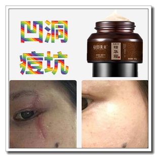 祛除凹陷痘疤痕灵快速淡化凹坑去痘坑修复凹洞生长膏芦荟胶霜产品