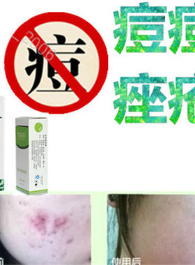 正品痘痘印痘疤祛后背部修复液胸前豆豆去除男女士痤疮印暗疮产品