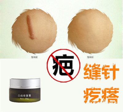 修复祛除增生性凸出疙瘩去手术后碰伤缝针伤疤痕印灵色素印精华液