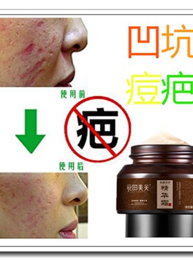 淡化痘疤痕灵祛除凹陷痘坑去手术刀疤凹凸伤疤修复膏霜祛痘印正品