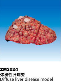 ZM2024弥漫性肝病变解剖模型