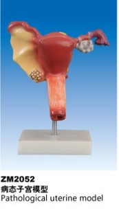 ZM2052病态子宫解剖模型
