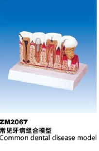 ZM2067常见牙病组合模型
