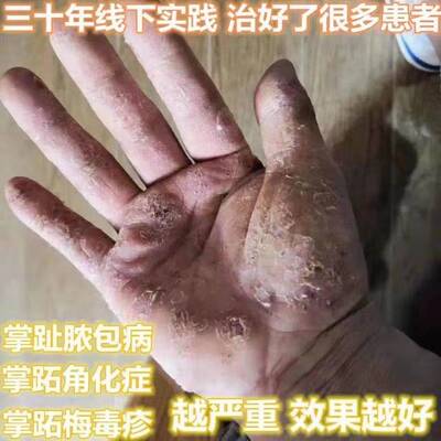 掌趾脓疱病掌跖角化症专用药膏