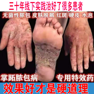 掌跖角化症掌趾脓包病手脚蜕皮干裂红斑角皮症掌跖脓疱病外用药膏