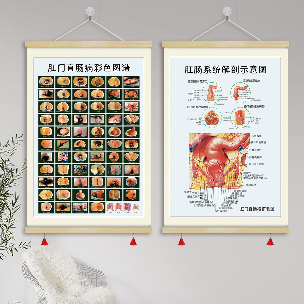 肛门直肠病彩色图谱痔疮解剖图医院肛肠科宣传画挂画装饰画GZY06