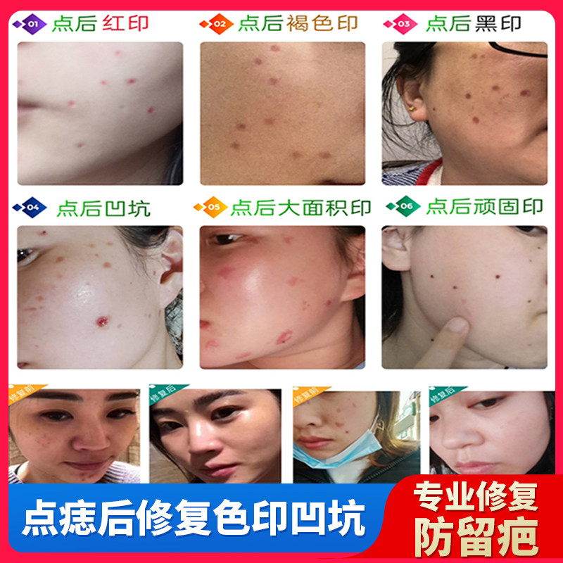 专用退红修复液激光点斑点痣后红印黑印痘印淡化黑色素退红修复仪