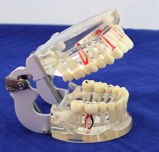 i透明成人综合口腔病理模型牙齿模型牙周病龋齿演示模型