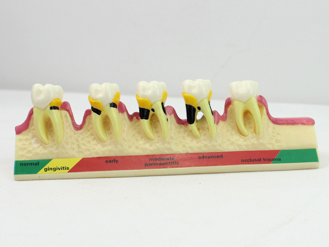 enovo颐诺口腔牙周学分类模型 牙龈炎度慢性牙周炎牙医沟通 刷牙指导