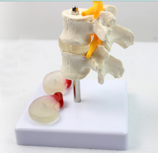 骨骼脊柱脊椎骨科模型骨科科中医脊柱骨科腰椎椎间盘膨出医院展示标本演示 ENOVO颐诺人体腰椎椎间盘突出模型