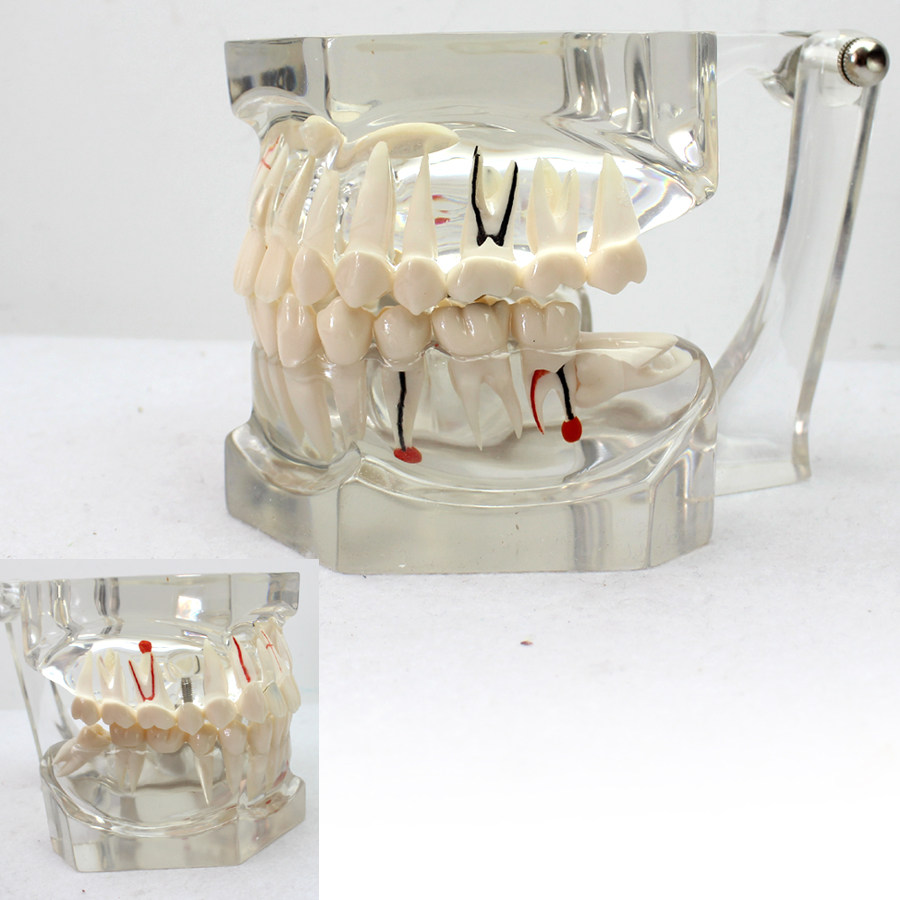 enovo颐诺放大版口腔病理2倍透明牙体病理模型 牙齿模型 种植龋齿口腔