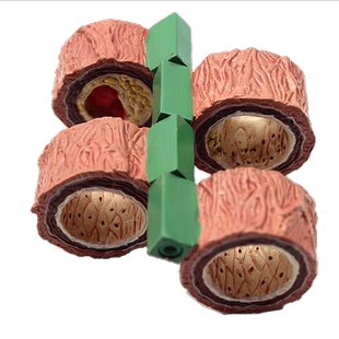 ENOVO颐诺动脉粥样硬化模型血栓病变模型心血管模型内科学生命健康心脑血管冠状动脉冠心病教育健康教具