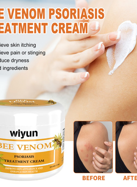 Bee Venom Psoriasis Cream Repair Hand and Foot Skin Moss Red