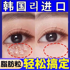 脂肪粒去除神器汗管瘤眼部去眼部眼角周油脂粒眼霜精华液男女专用