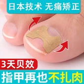 甲沟炎矫正神器嵌甲指甲矫正器大脚趾甲长肉里免胶水拉正甲贴片
