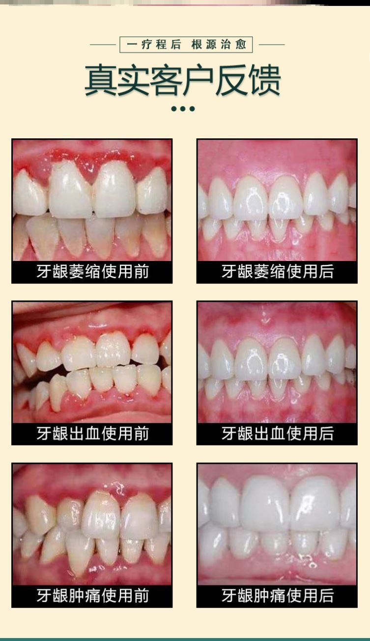 牙龈萎缩修复再生牙缝填充牙缝牙齿松动牙龈修复膏