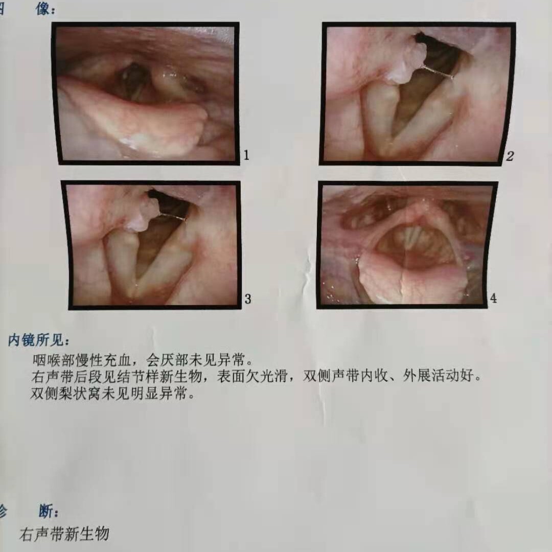 声带新生物息接触性肉芽肿物小结肥厚音嘶咽痛沙哑费劲闭合不全