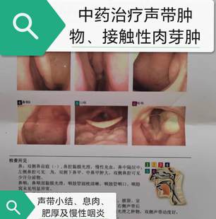 声带息接触性肉芽肿物肥厚小结咽喉咙疼痛任克氏水囊肿音沙嘶哑炎